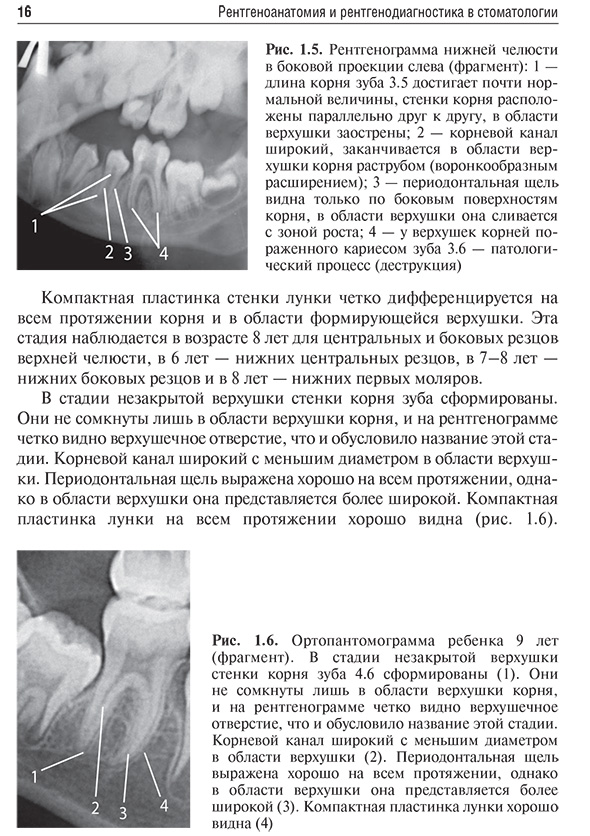 Рис. 1.6. Ортопантомограмма ребенка 9 лет (фрагмент). В стадии незакрытой верхушки Рис. 1.6. Ортопантомограмма ребенка 9 лет (фрагмент). В стадии незакрытой верхушки