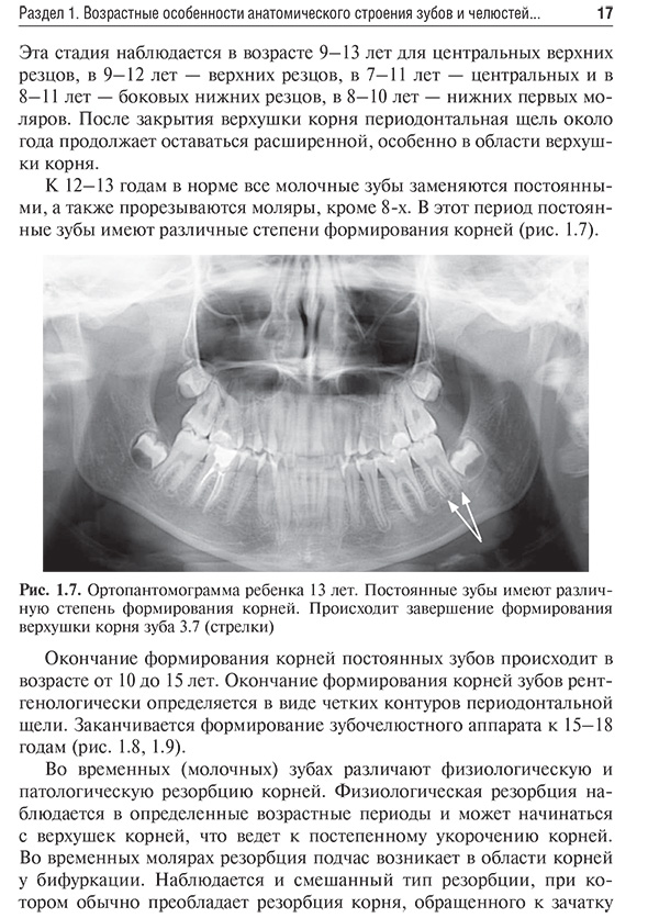 Ортопантомограмма ребенка 13 лет. Постоянные зубы Ортопантомограмма ребенка 13 лет. Постоянные зубы