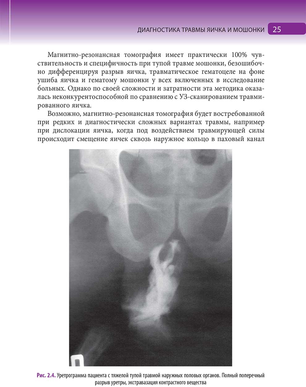 Уретрограмма пациента с тяжелой тупой травмой наружных половых органов