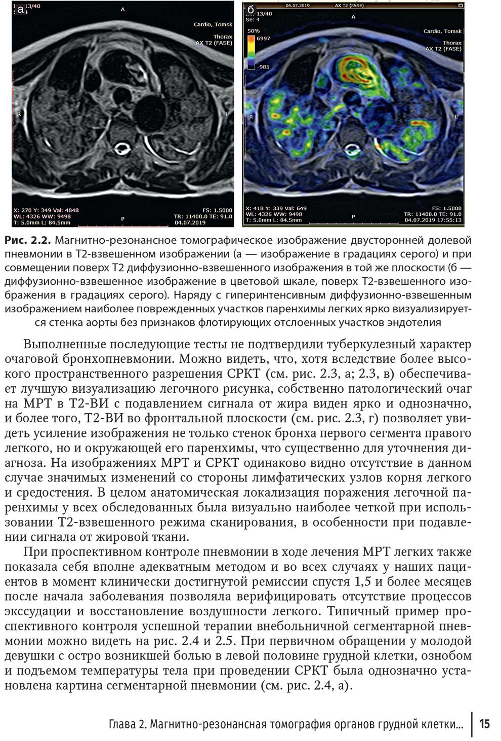 Рис. 2.2. Магнитно-резонансное томографическое изображение двусторонней долевой пневмонии в Т2-взвешенном изображении 
