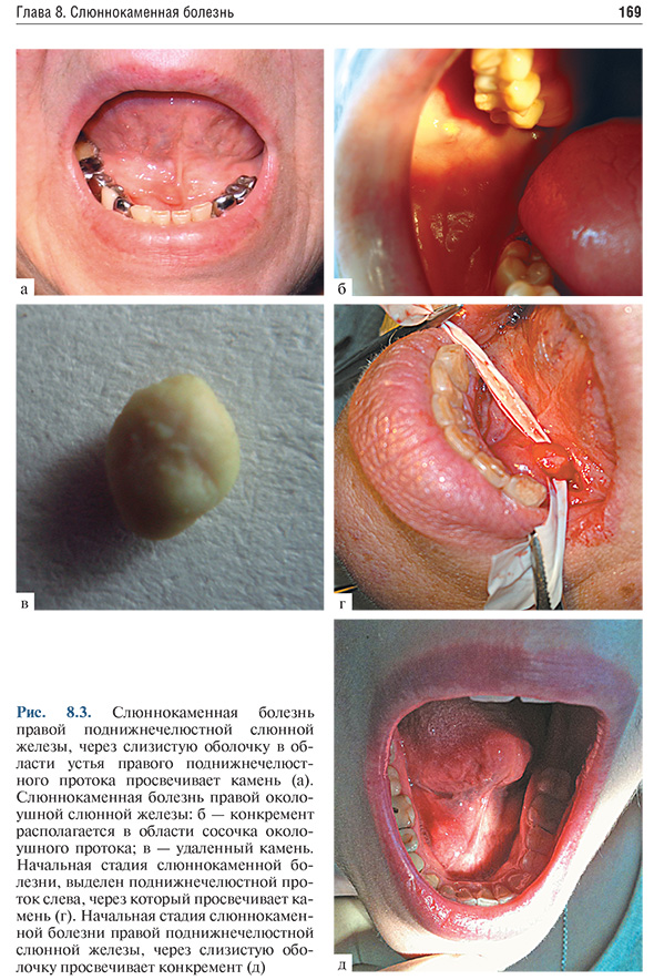 Рис. 8.3. Слюннокаменная болезнь правой поднижнечелюстной слюнной железы, через слизистую оболочку