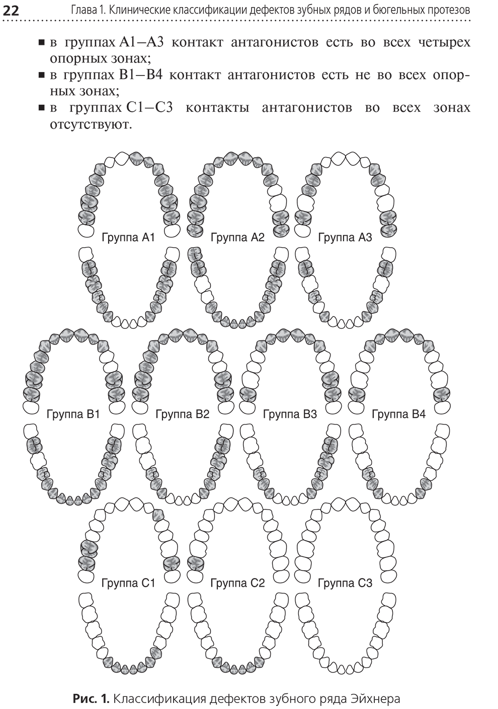 Рис. 1. Классификация дефектов зубного ряда Эйхнера