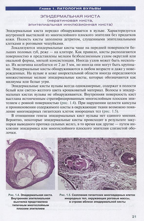 Эпидермальная киста. Эпидермальная киста.