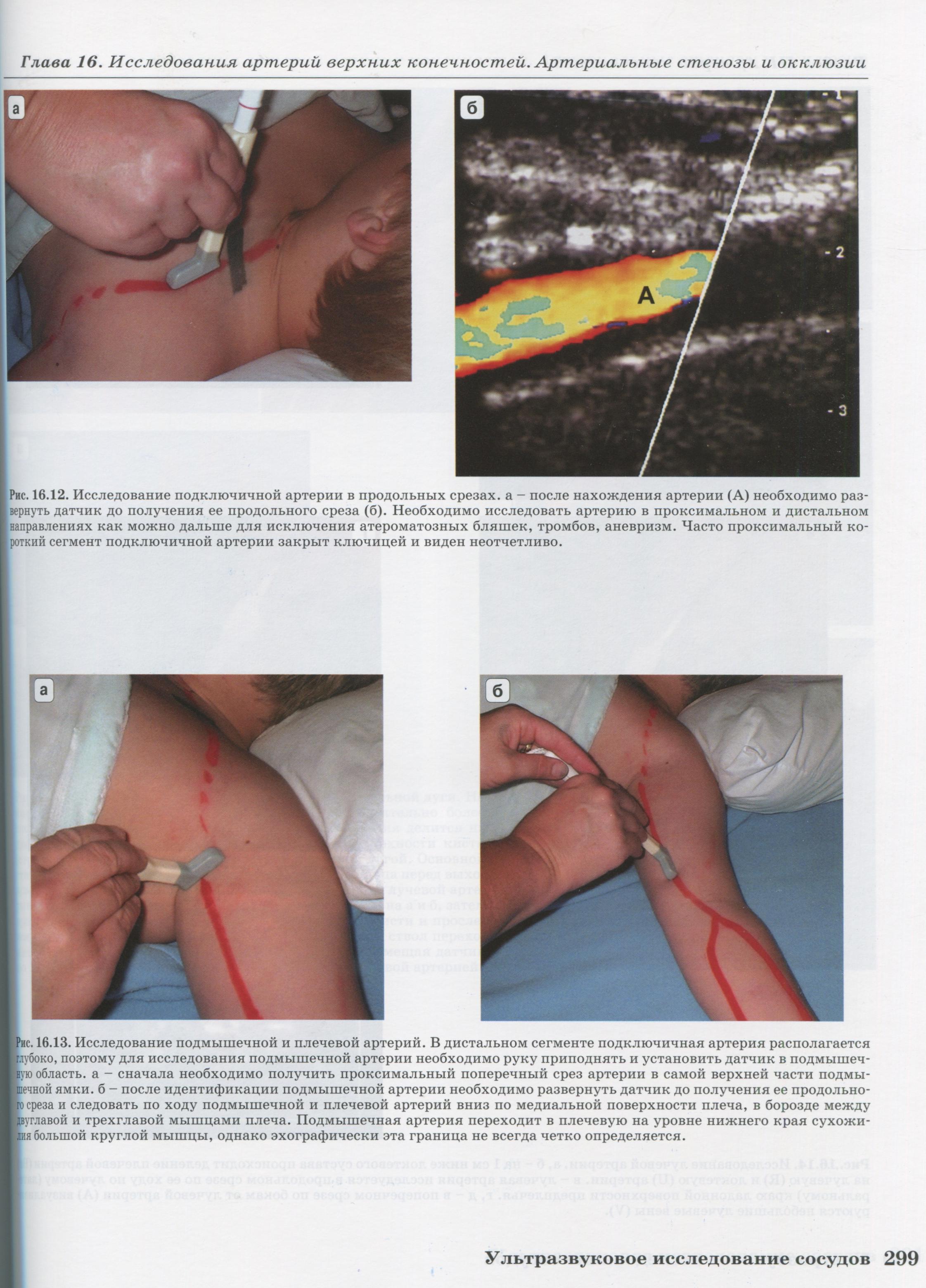 Исследование подмышечной и плечевой артерий