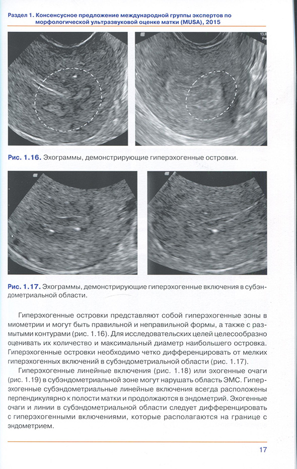 Рис. 1.17. Эхограммы, демонстрирующие гиперэхогенные включения в субэндометриальной области.