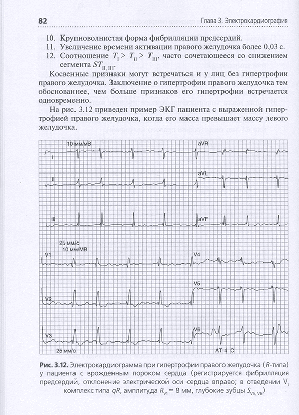 Электрокардиограмма при гипертрофии правого желудочка