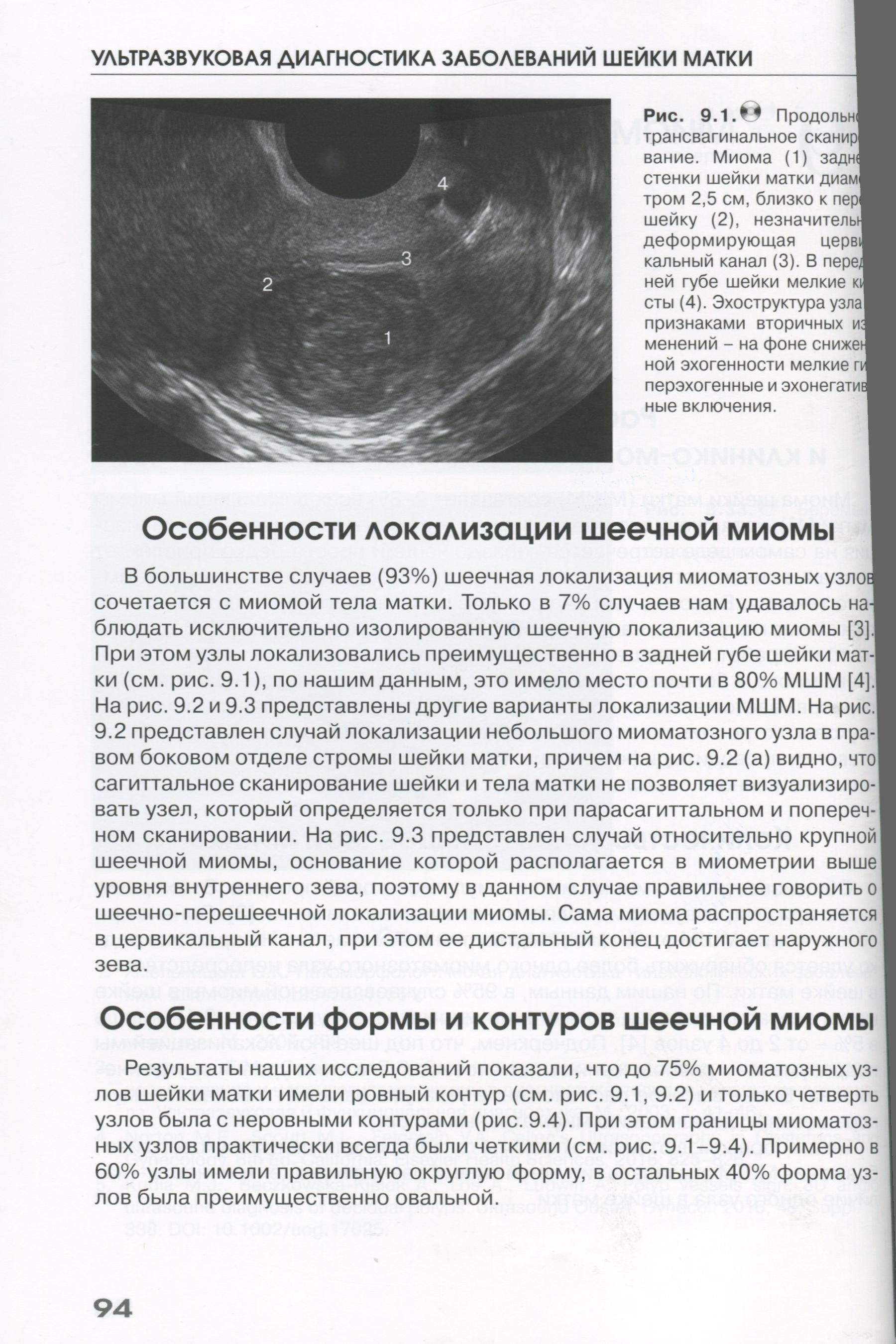 Продольное трансвагинальное сканирование Продольное трансвагинальное сканирование