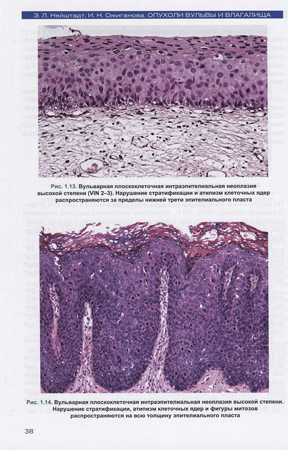 Вульварная плоскоклеточная интраэпителиальная неоплазия высокой степени Вульварная плоскоклеточная интраэпителиальная неоплазия высокой степени
