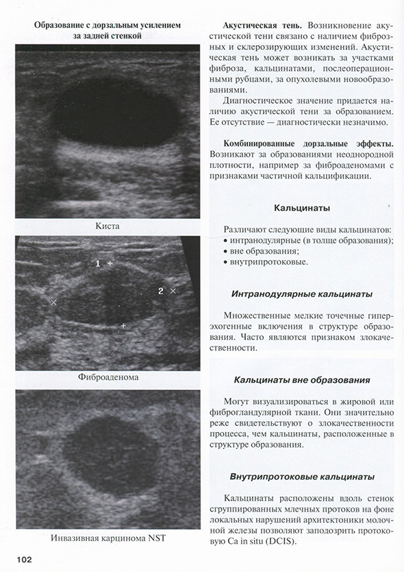 Образование с дорзальным усилением за задней стенкой Образование с дорзальным усилением за задней стенкой