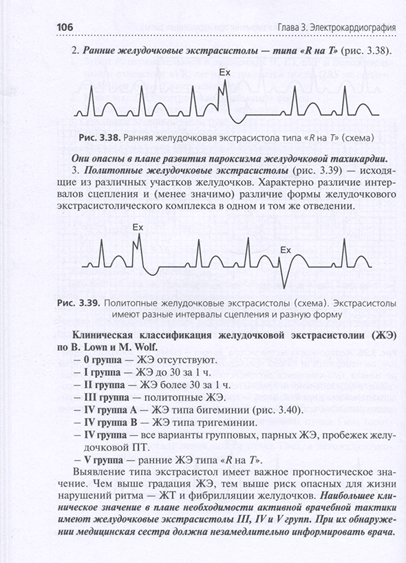 Полигонные желудочковые экстрасистолы (схема)