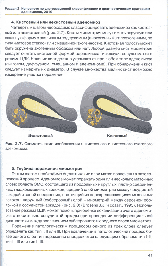 Рис. 2.7. Схематические изображения некистозного и кистозного очагового аденомиоза.