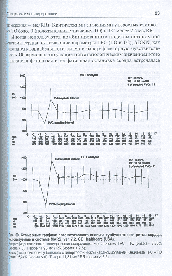 Суммарные графики автоматического анализа турбулентности ритма сердца