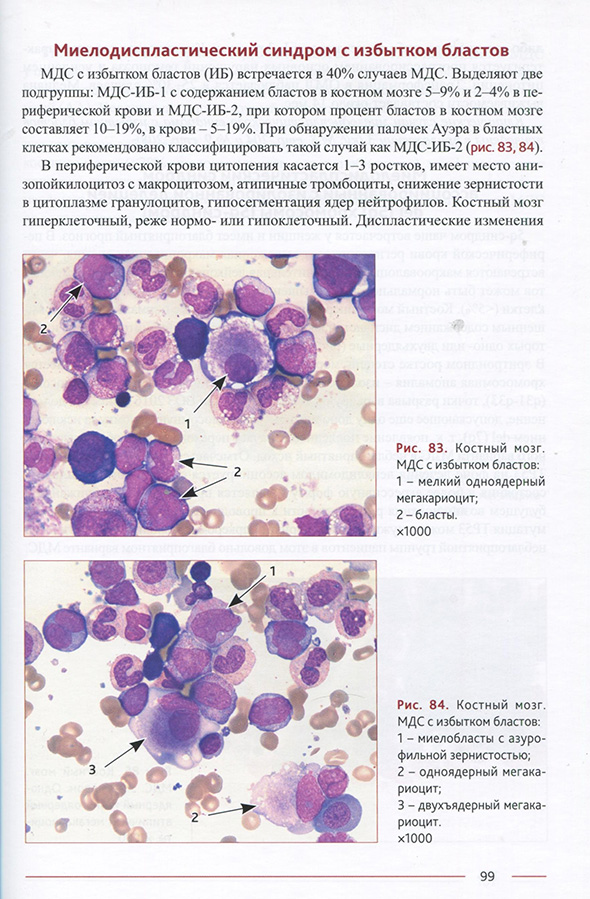 Рис. 83. Костный мозг. МДС с избытком бластов