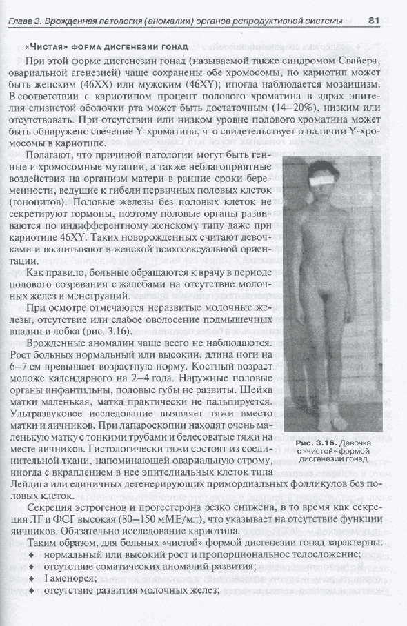 Девочка с "чистой" формой дисгенезии гонад Девочка с "чистой" формой дисгенезии гонад