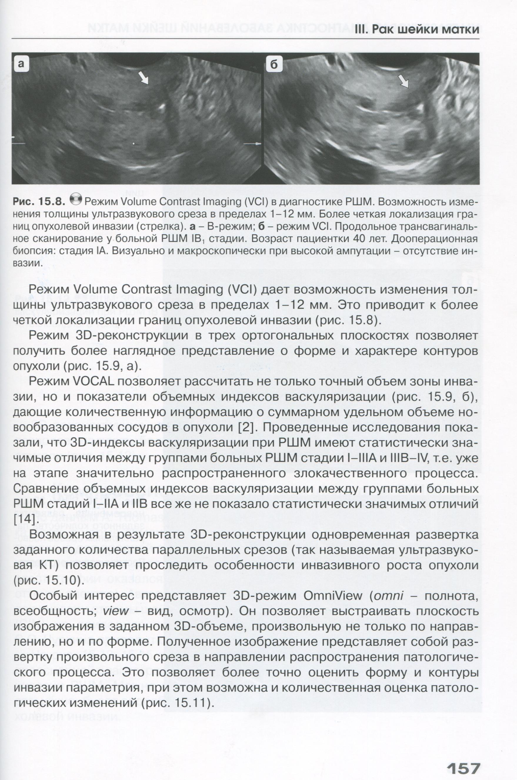 Рис. 15.8. Режим Volume Contrast Imaging (VCI) в диагностике РШМ. Рис. 15.8. Режим Volume Contrast Imaging (VCI) в диагностике РШМ.