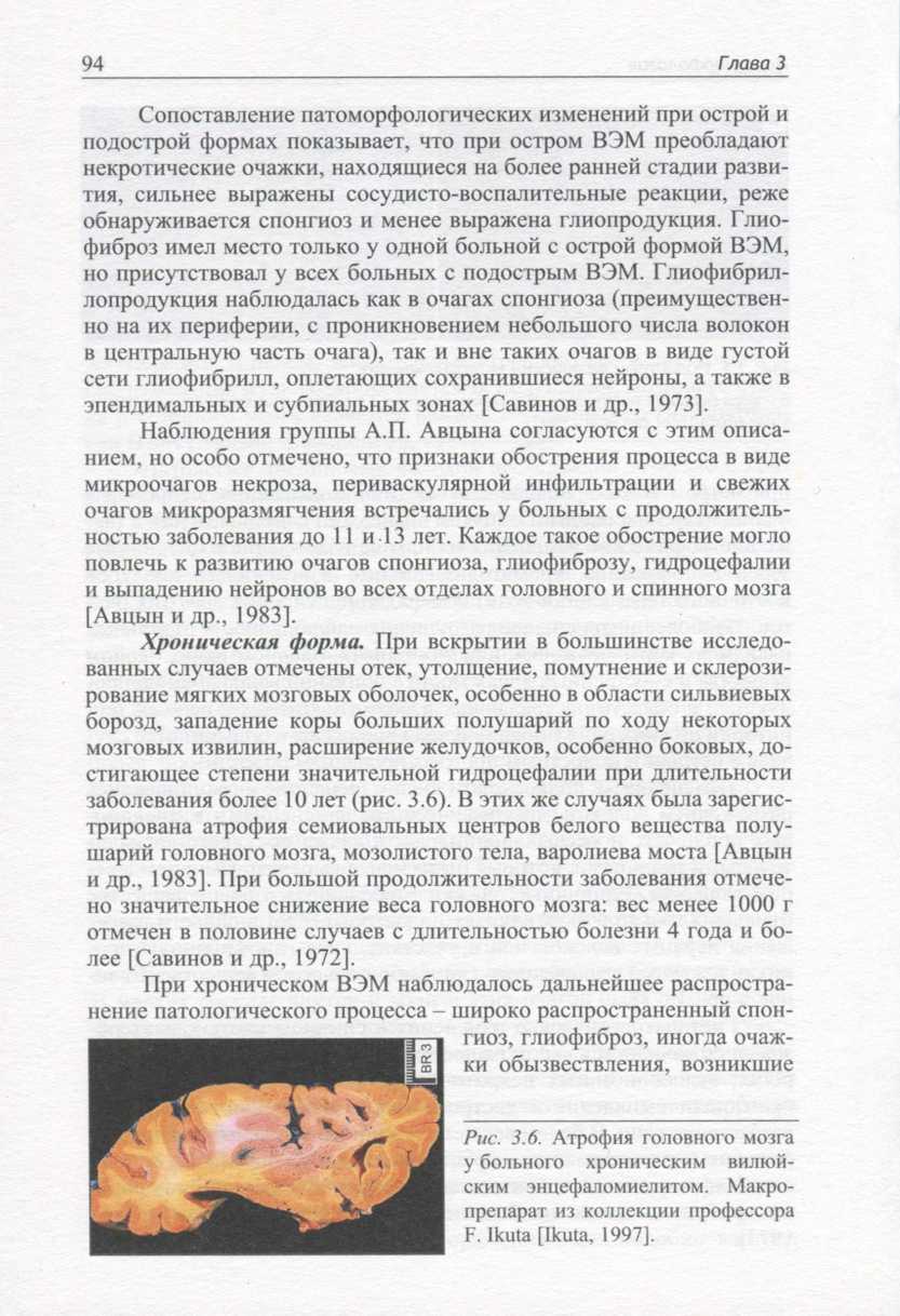 Атрофия головного мозга у больного хроническим вилюйским энцефаломиелитом Атрофия головного мозга у больного хроническим вилюйским энцефаломиелитом