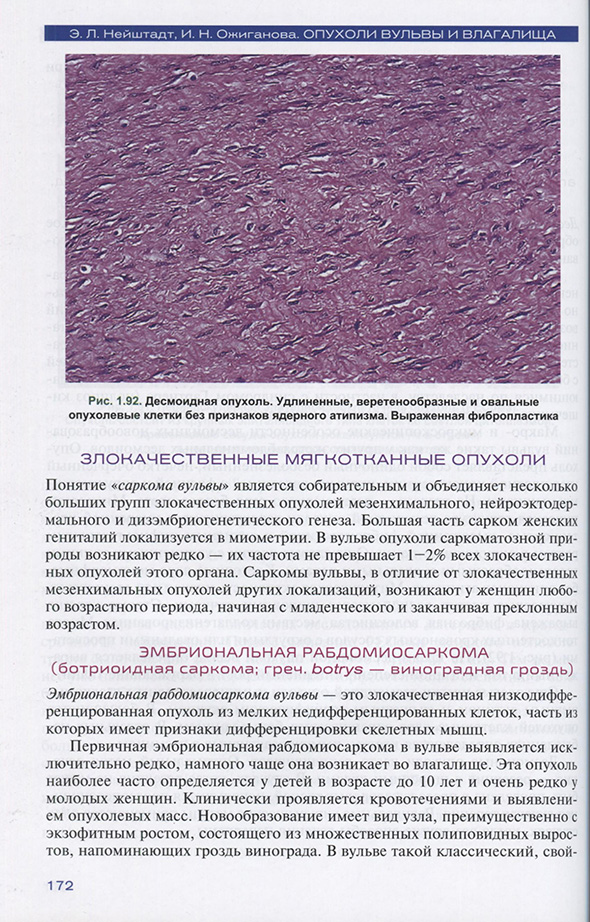 Десмоидная опухоль. Десмоидная опухоль.