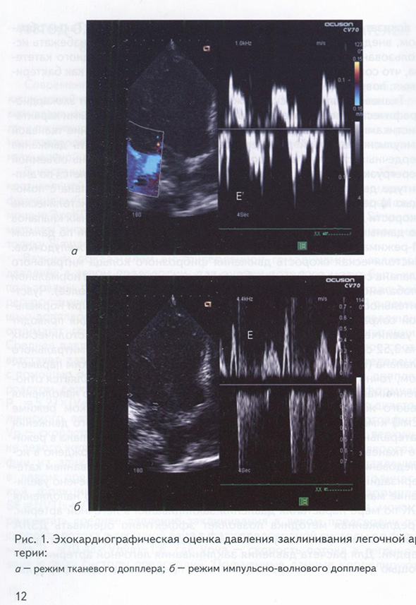 Эхокардиографическая оценка давления заклинивания