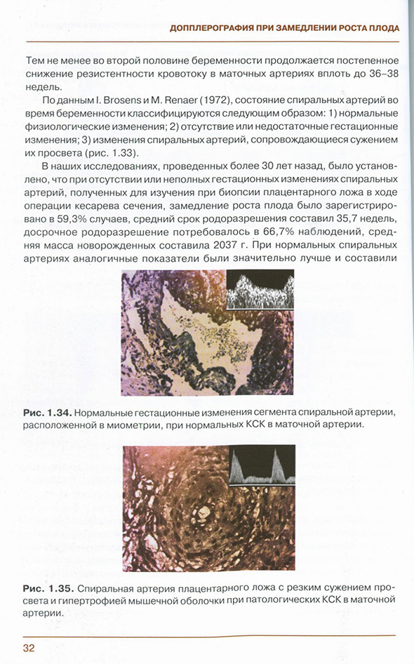 Нормальные гестационные изменения сегмента спиральной артерии,