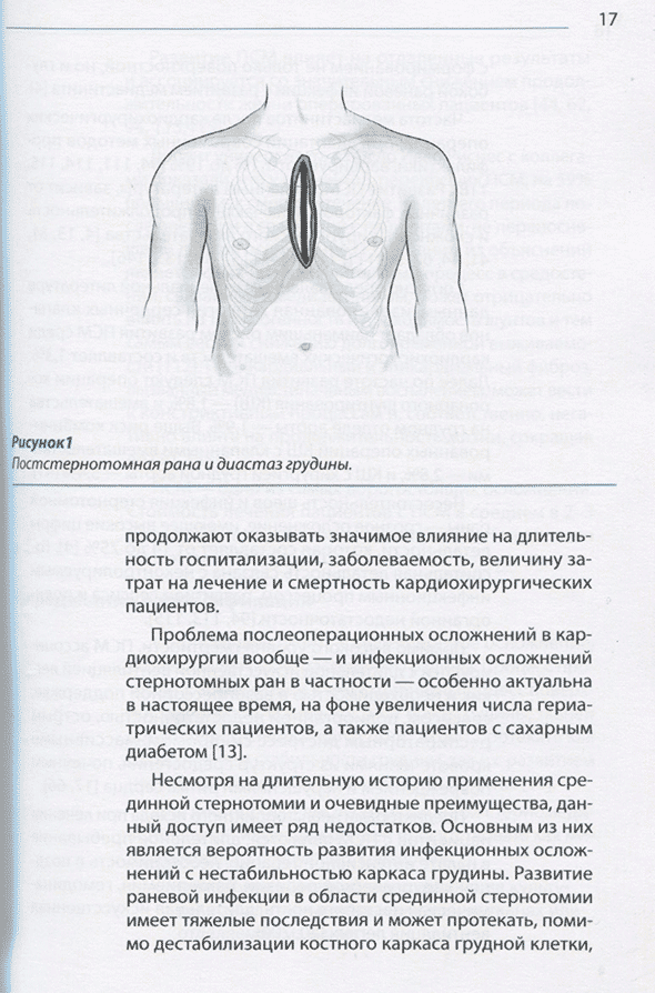 Постстернотомная рана и диастаз грудины.