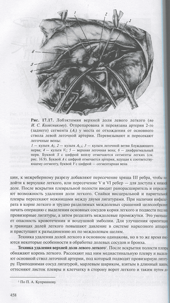 Лобэктомия верхней доли левого легкого