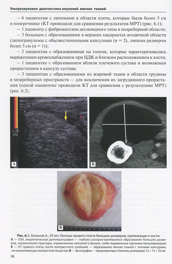 Липома правого плеча больших размеров, прилежащая к кости
