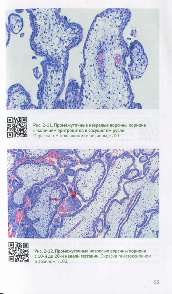 Промежуточные незрелые ворсины хориона с наличием эритроцитов в сосудистом русле.