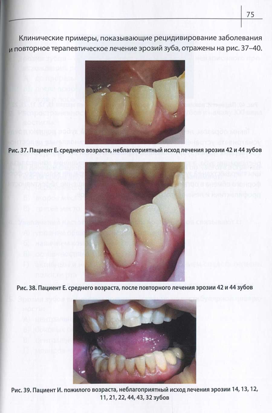 Рис. 37. Пациент Е. среднего возраста, неблагоприятный исход лечения эрозии 42 и 44 зубов