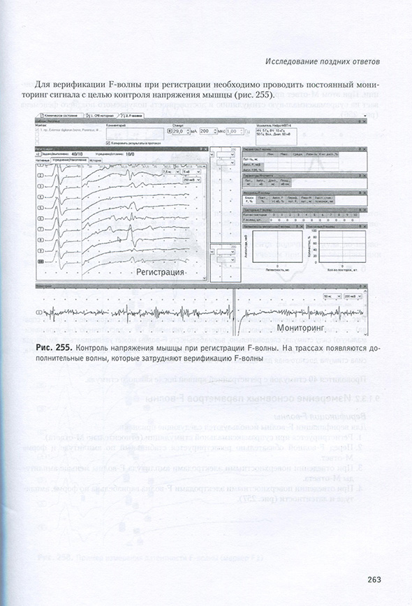 Контроль напряжения мышцы при регистрации F-вопны.