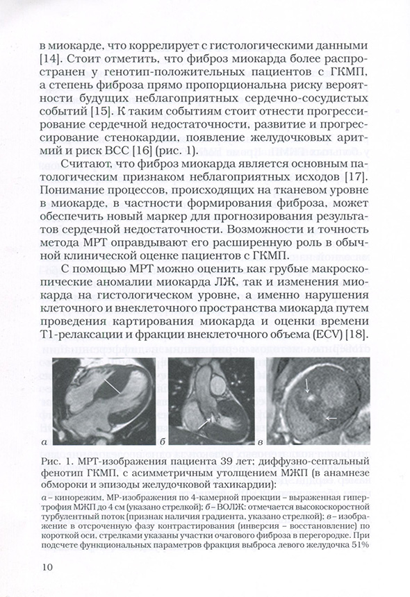 MPT-изображения пациента 39 лет: диффузно-септальный фенотип ГКМП. с асимметричным утолщением МЖП MPT-изображения пациента 39 лет: диффузно-септальный фенотип ГКМП. с асимметричным утолщением МЖП