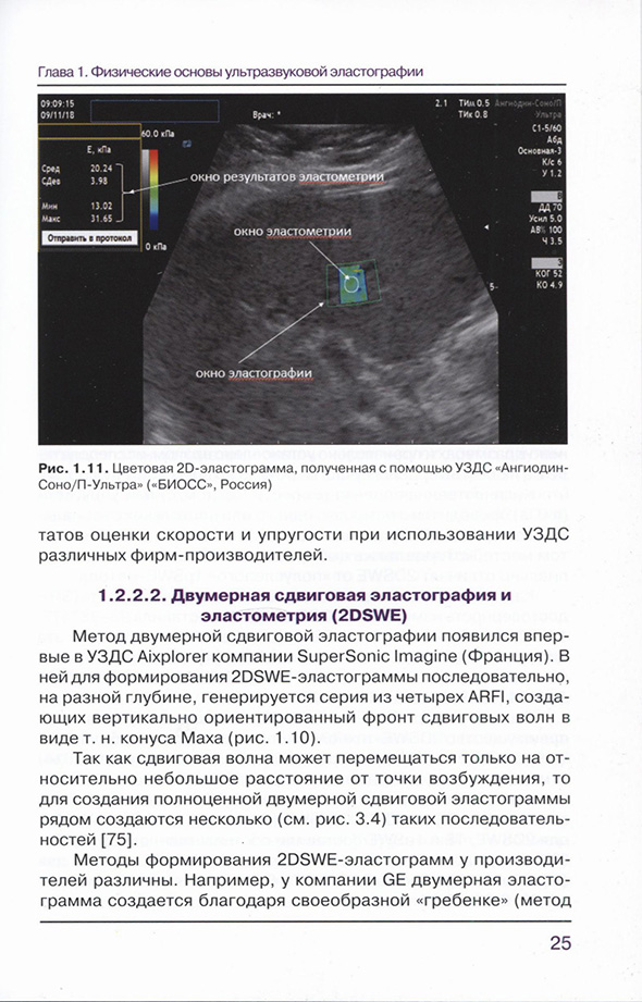 Цветовая 2D-эластограмма. полученная с помощью УЗДС Цветовая 2D-эластограмма. полученная с помощью УЗДС