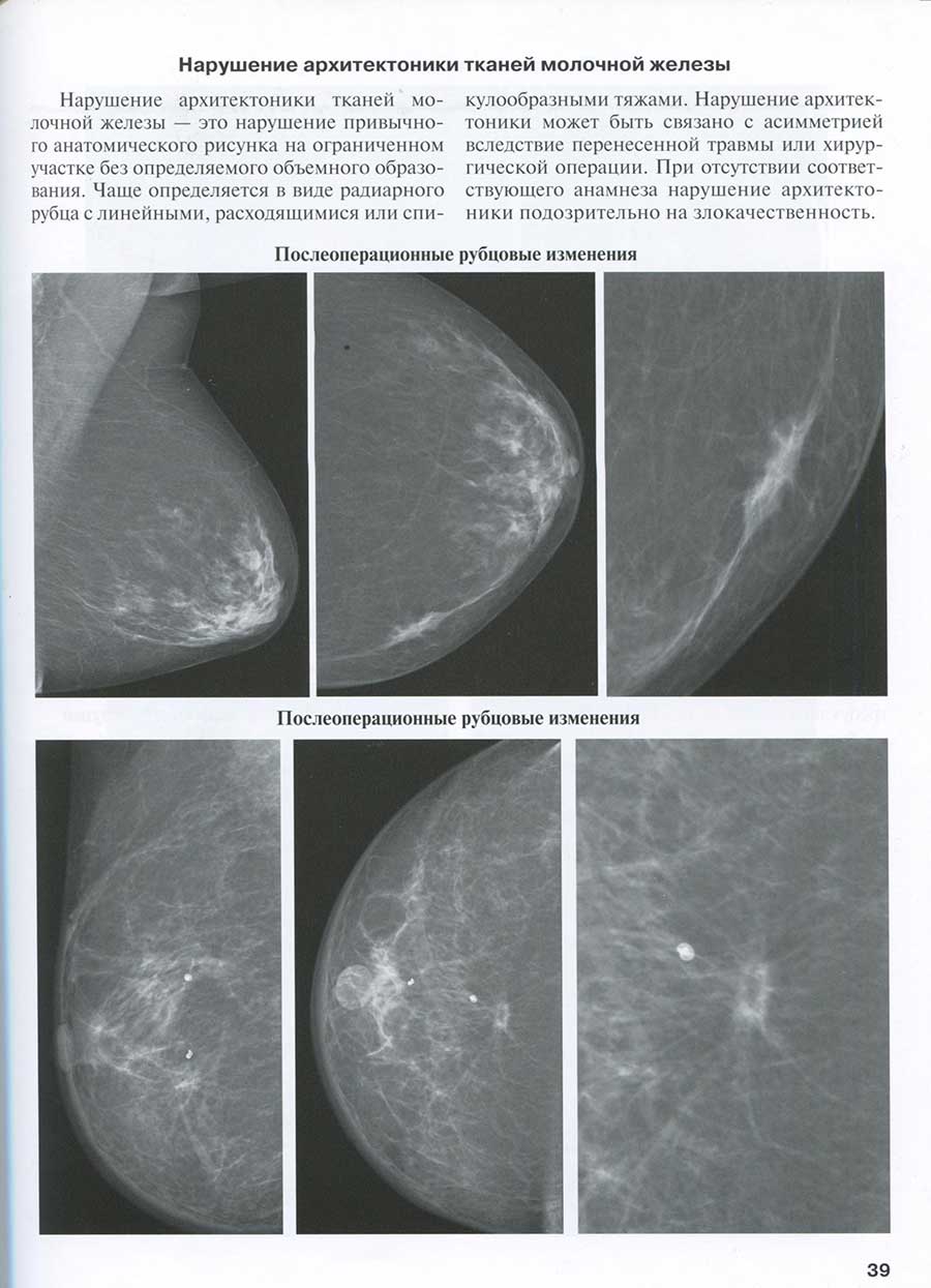 Нарушение архитектоники тканей молочной железы Нарушение архитектоники тканей молочной железы