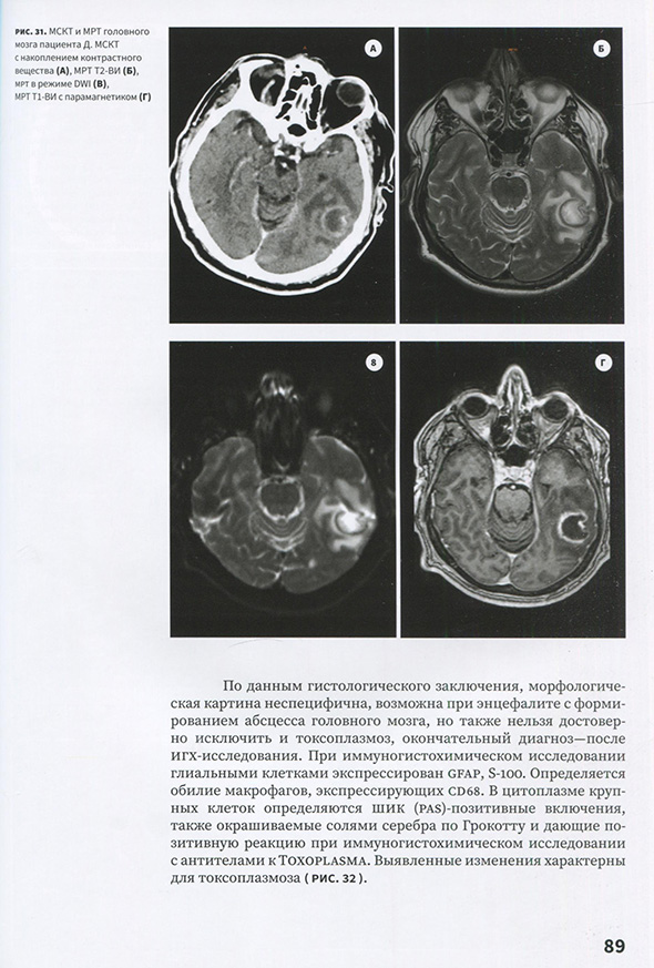 МСКТ и МРТ головного мозга пациента Д. МСКТ с накоплением контрастного вещества (А), МРТ Т2-ВИ (Б),