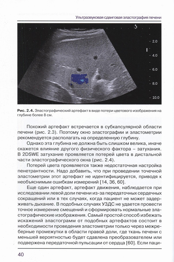 Рис. 2.4. Эластографический артефакт в вило потери цветового изображения на глубине более 8 см. Рис. 2.4. Эластографический артефакт в вило потери цветового изображения на глубине более 8 см.