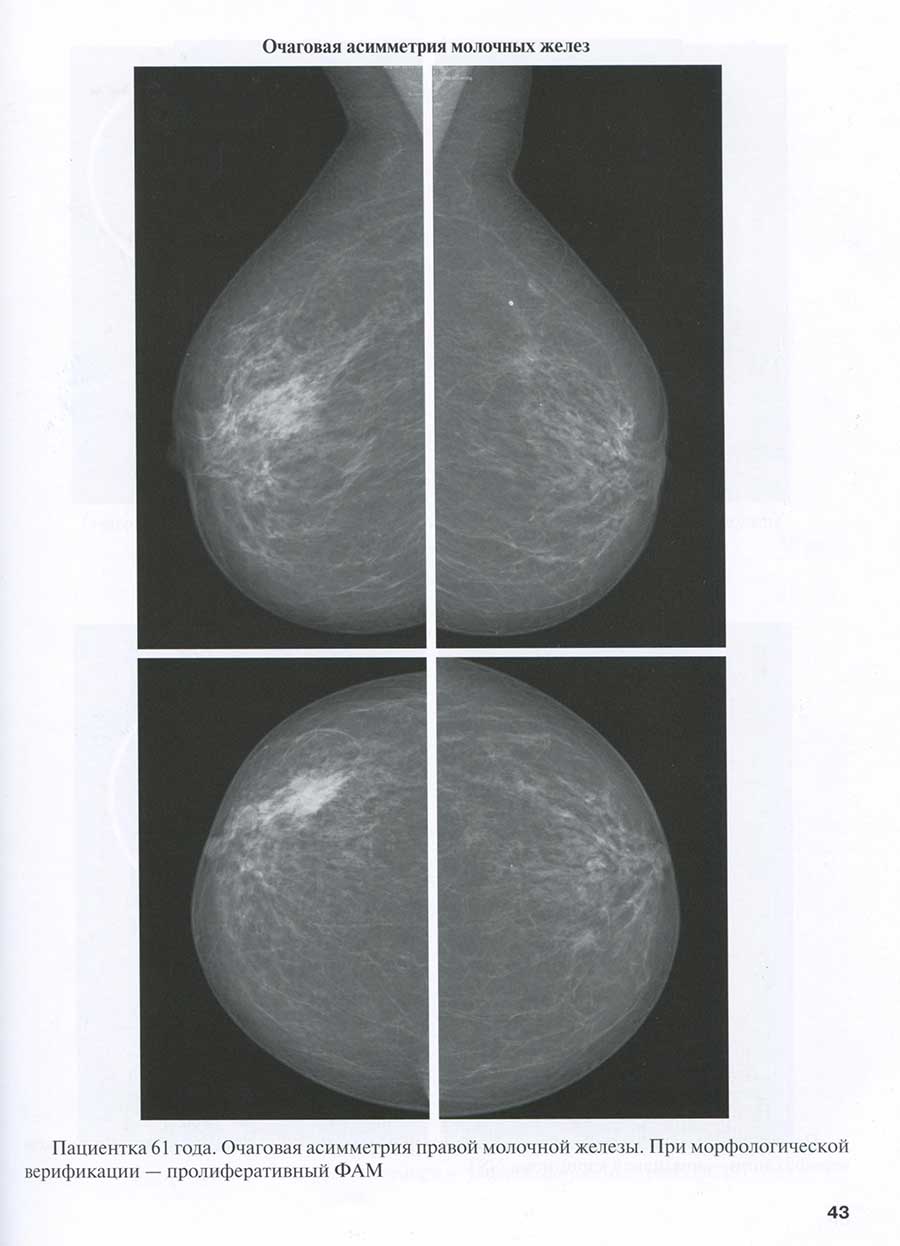 Очаговая асимметрия молочных желез Очаговая асимметрия молочных желез