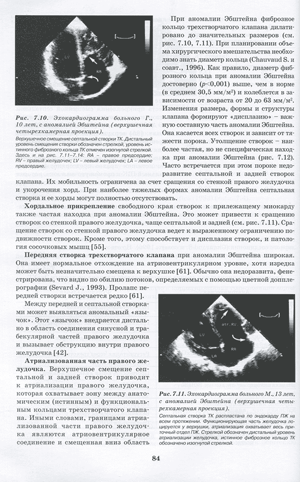 Рис. 7.11. Эхокардиограмма больного М.. 13 лет. с аномалией Эбштейна (верхушечная четырехкамерная проекция). Рис. 7.11. Эхокардиограмма больного М.. 13 лет. с аномалией Эбштейна (верхушечная четырехкамерная проекция).