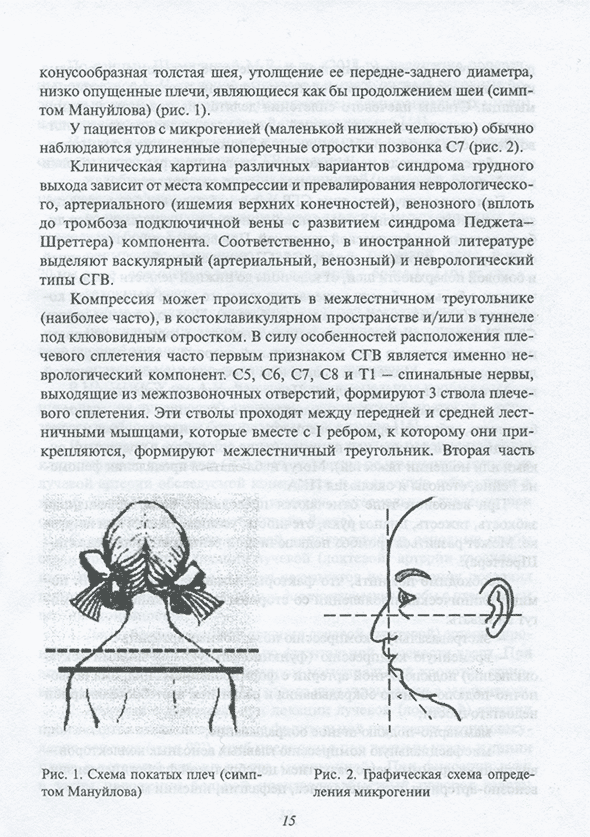 Рис. 1. Схема покатых плеч (симптом Мануйлова)
