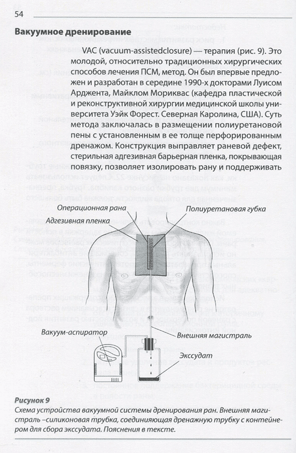 Схема устройства вакуумной системы дренирования ран.