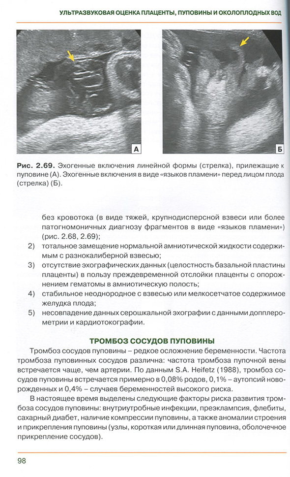 Эхогенные включения линейной формы (стрелка)