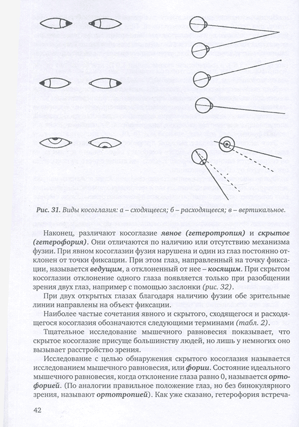 Виды косоглазия Виды косоглазия