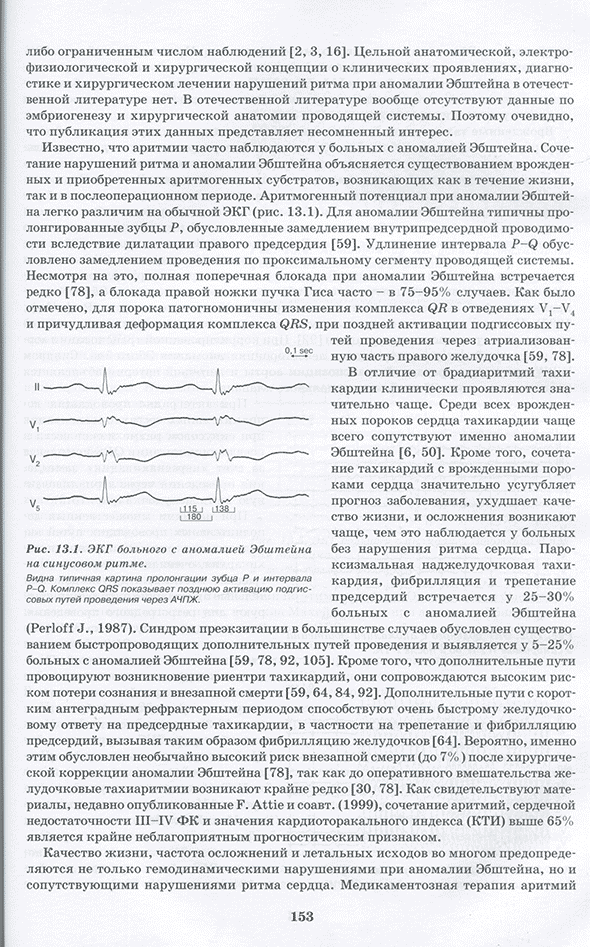 Рис. 13.1. ЭКГ больного с аномалией Эбштейна на синусовом ритме. Рис. 13.1. ЭКГ больного с аномалией Эбштейна на синусовом ритме.