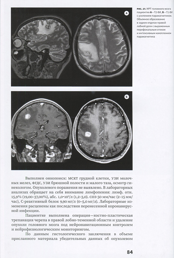  MPT головного мозга пациентки А—Т2-ВИ, Б—Т1-ВИ с усилением парамагнетиком