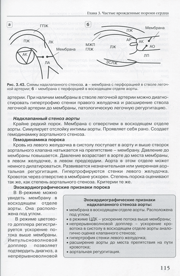 Схемы надклапанного стеноза. Схемы надклапанного стеноза.
