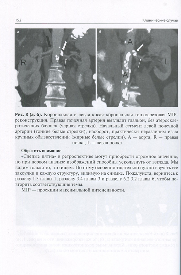 Корональная и левая косая корональная тонкосрезовая МIР-реконструкция. Правая почечная артерия выглядит гладкой Корональная и левая косая корональная тонкосрезовая МIР-реконструкция. Правая почечная артерия выглядит гладкой