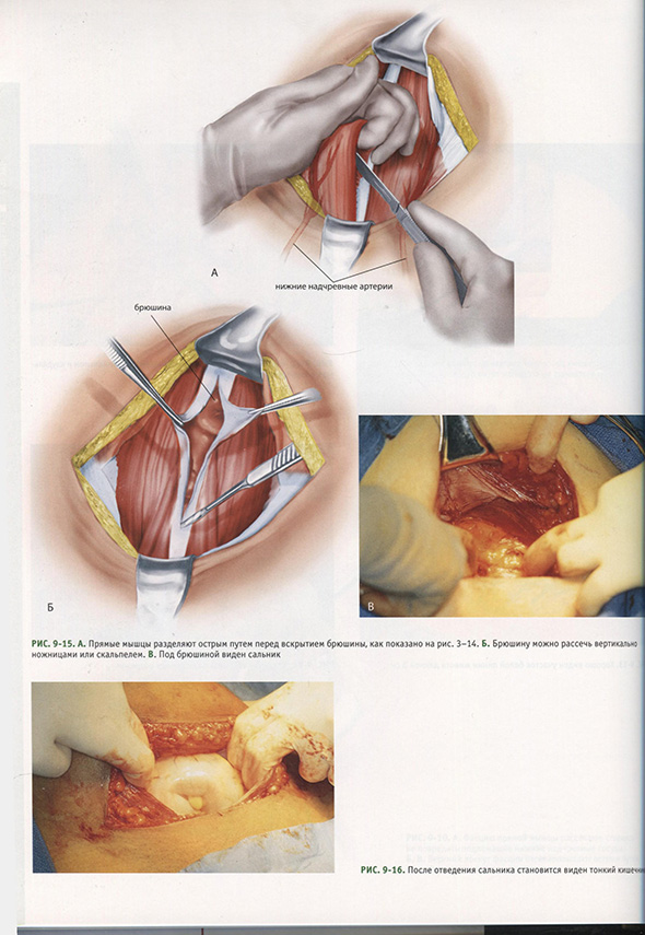 Прямые мышцы разделяют острым путем перед вскрытием брюшины Прямые мышцы разделяют острым путем перед вскрытием брюшины