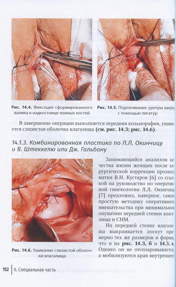 Ушивание слизистой оболочки влагалища
