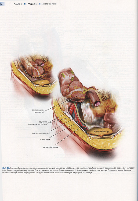 Быстрая, безопасная и относительно легкая техника вхождения в забрюшинное пространство. Быстрая, безопасная и относительно легкая техника вхождения в забрюшинное пространство.