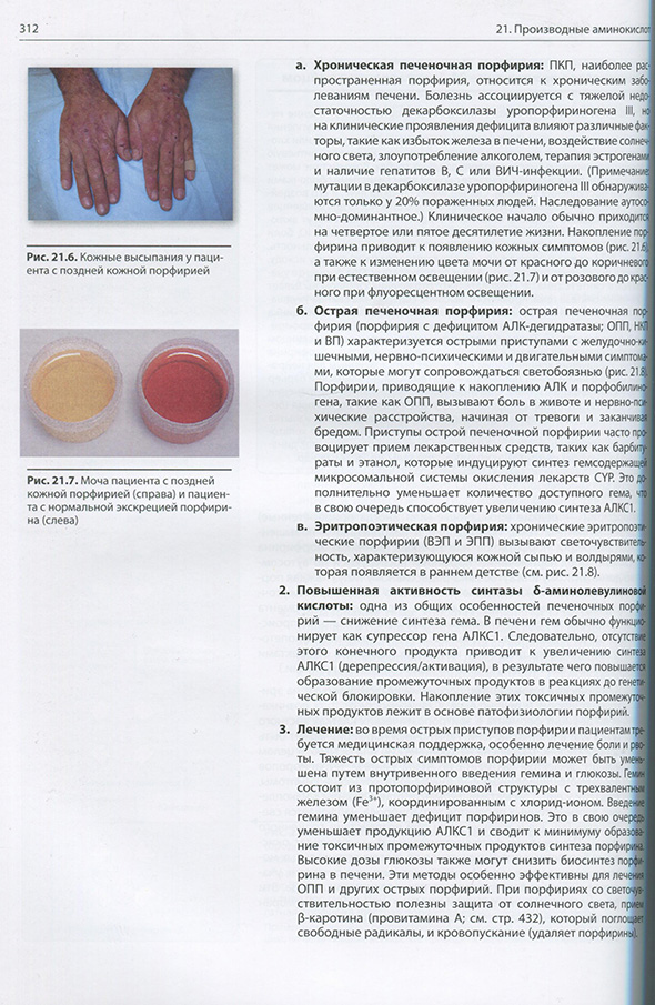 Рис. 21.7. Моча пациента с поздней кожной порфирией (справа) и пациента с нормальной экскрецией порфирина (слева) Рис. 21.7. Моча пациента с поздней кожной порфирией (справа) и пациента с нормальной экскрецией порфирина (слева)