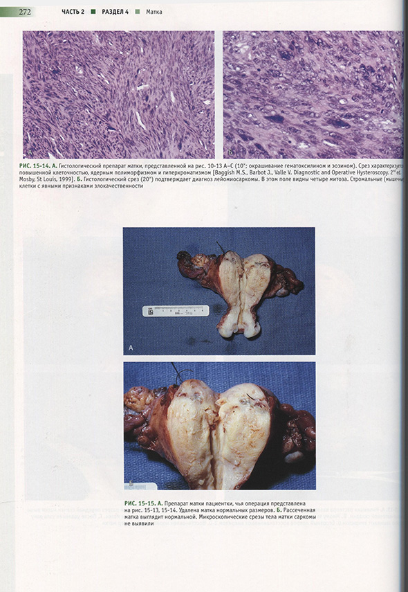 А. Препарат матки пациентки, чья операция представлена А. Препарат матки пациентки, чья операция представлена