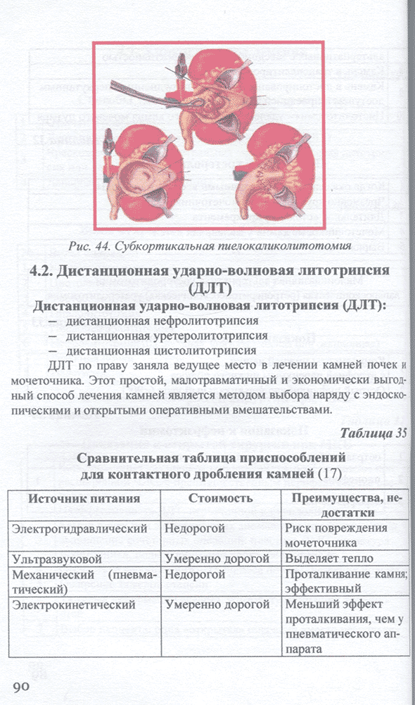 Субкортикальная пиелокаликолитотомия